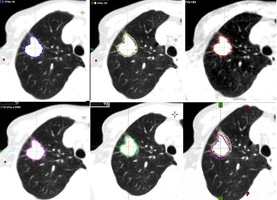 Evaluation of Lung Tumor Target Volume in a Large Sample: Target and Clinical Factors Influencing the Volume Derived From Four-Dimensional CT and Cone Beam CT